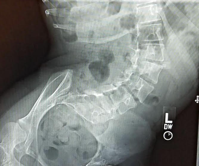 Scoliosis from Giant Axonal Neuropathy (GAN)